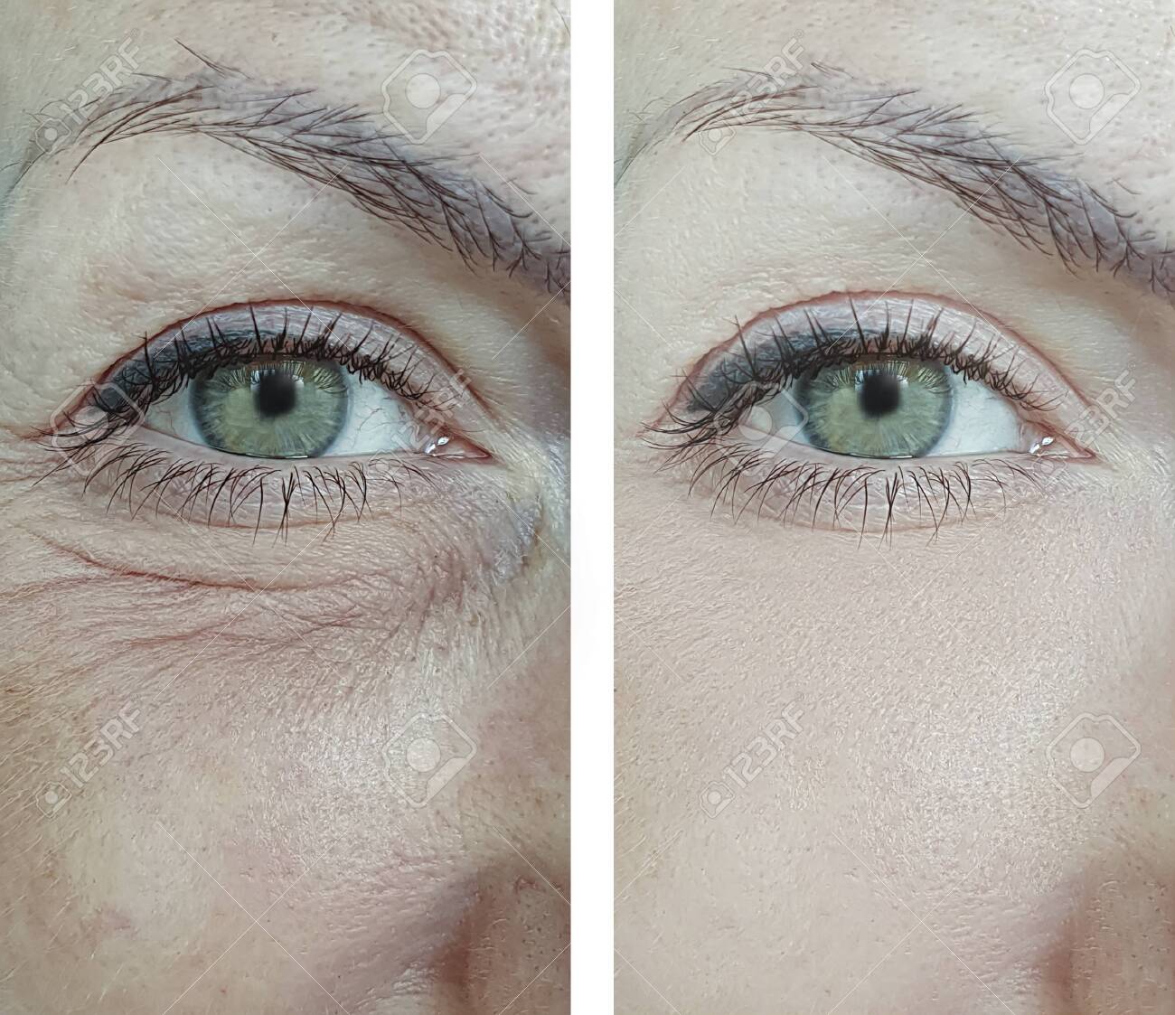 🔥 LuteinLift™ Anti-Wrinkle Eye Oil — Erase Fine Lines Before They Become Permanent