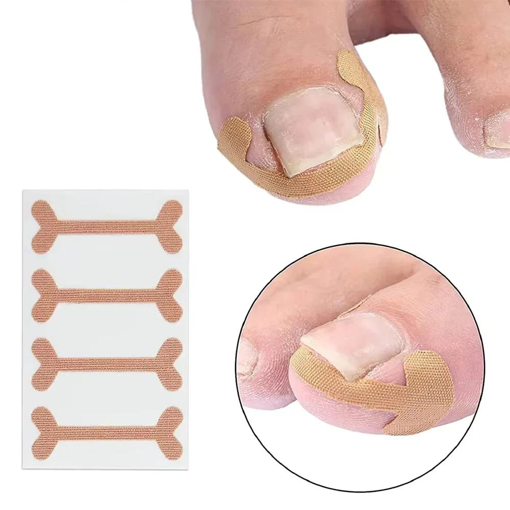 Ingrown Toenail Tools Set - Image 5